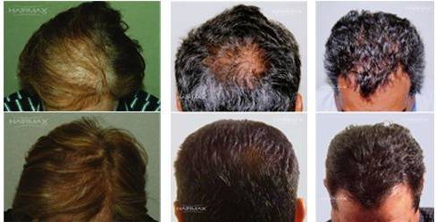 laser hair loss treatment therapy atlanta ga